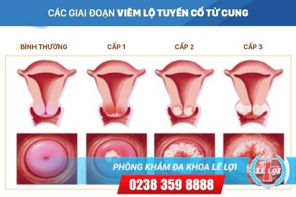 Các giai đoạn viêm lộ tuyến cổ tử cung