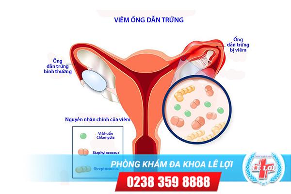 Viêm ống dẫn trứng và những điều cần biết